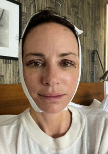 Catt Saddler After Facelift Surgery